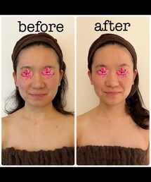 ブライダルコースビフォーアフター💍 | フェイスラインや顔幅、肩のラインにご注目✨(ビューティーグッズ)